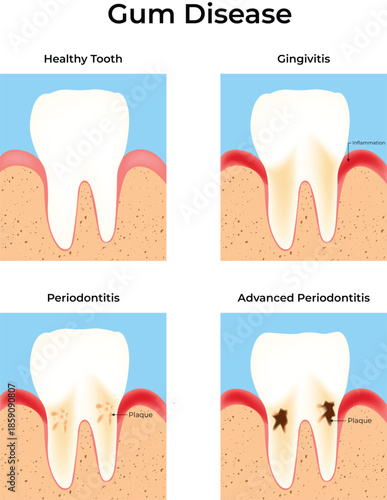 Stages of Gum Disease Progression From Healthy to Advanced Periodontitis Vector Illustration