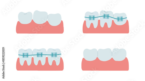 Illustration showing the process of straightening teeth with braces over time.