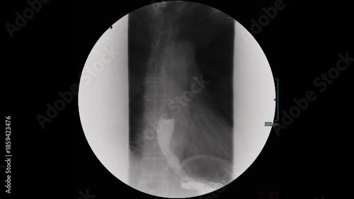 Barium swallow X-ray is used to detect abnormalities in the upper gastrointestinal tract and stomach.