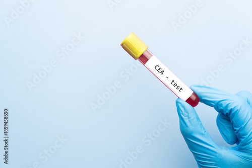 Doctor holding a test blood sample tube with CEA (Carcinoembryonic Antigen) test, tumor marker for colorectal cancer.