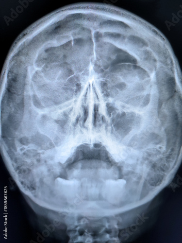 Φωτογραφία X-ray image of human skull focusing on sinuses, showing frontal and maxillary cavities, used for medical diagnosis of sinus health and nasal structure