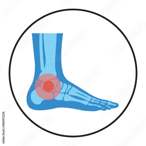 Ankle Illustration: A detailed anatomical illustration highlighting the ankle joint, featuring a vivid display of bone structure and focusing on the areas of pain and inflammation