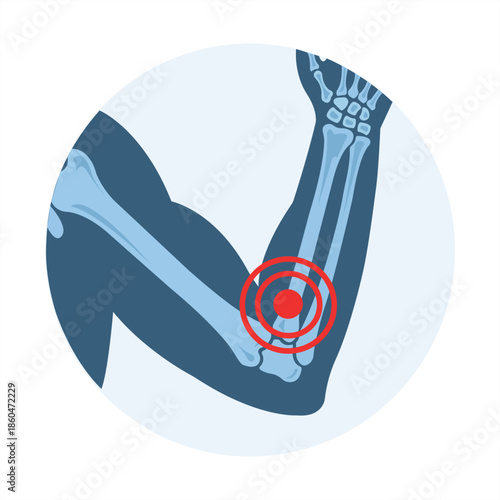 Elbow Pain Illustration: A medical illustration of an elbow and forearm reveals a highlighted area of pain, indicating potential injury or discomfort. 