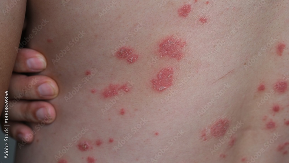 Fototapeta premium A man with his Psoriasis on his back.
