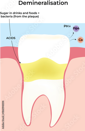 Tooth Demineralisation Process Explained vector illustration