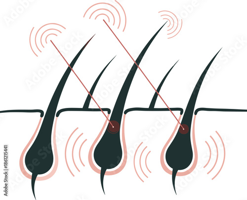 Of laser hair removal targeting hair follicles in the skin