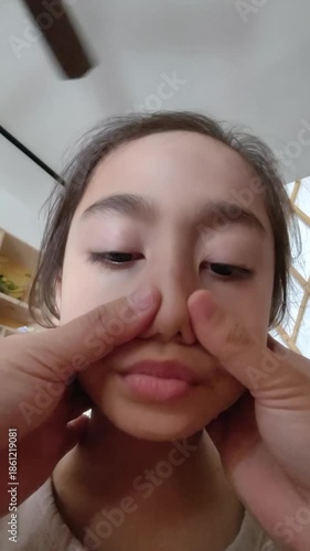 Medicated cream is spread on the little girl's face. Vertical.