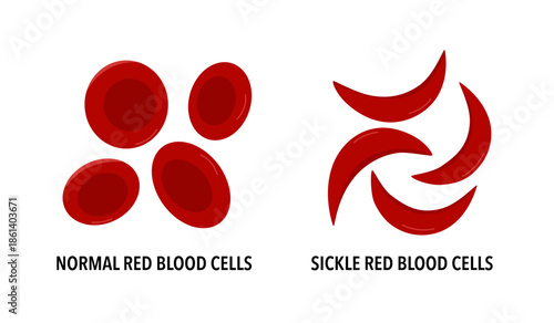 Sickle cell disease. The difference of Normal red blood cell and sickle cell medical vector illustration.
