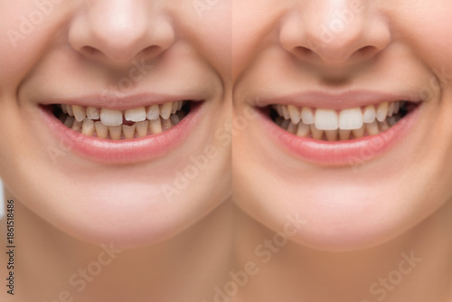 Collage of woman with diastema between upper front teeth before after treatment,showing big gap crack,older middle aged female needs stomatology dentist,medicine healthcare close up. 