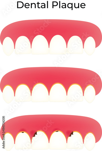 Dental Plaque and Tooth Decay Progression