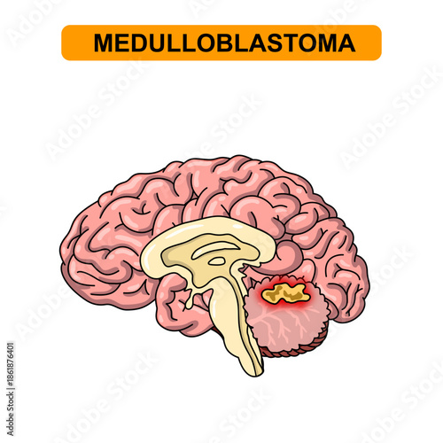 Illustration of medulloblastoma. Tumor, cancer in the human brain. Illustration of brain disease. Vector nerve illustration for medical concept, poster, diagram, science or health element infographic