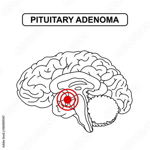 Illustration of pituitary adenoma. Tumor, cancer in the human brain. Illustration of brain disease. Vector line drawing illustration for medical concept, poster, diagram, science.