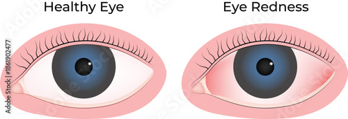 Healthy Eye vs Red Eye A Visual Comparison of Ocular Conditions