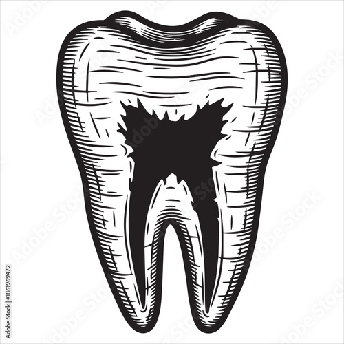 Black and white illustration of a human tooth with a large cavity dental decay