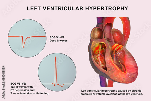 Left ventricular hypertrophy, 3D illustration showing thickened left ventricular myocardium with ECG examples in leads V1-V2 and V5-V6 demonstrating voltage changes