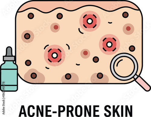 Acne Skin Care Illustration - Dermatology Treatment and Facial Blemish Anatomy Vector
