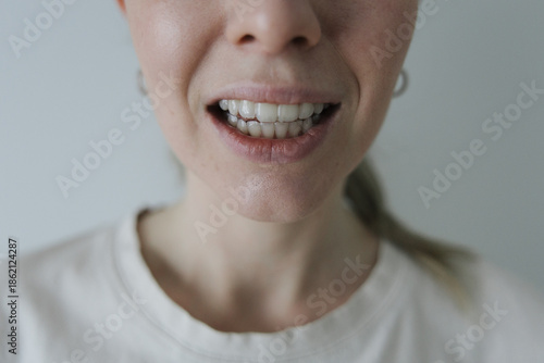 Close-up of a smiling woman wearing transparent dental aligners. Concept of modern dentistry, orthodontic care and oral health.