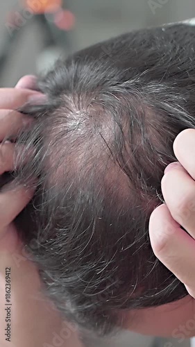 Androgenic alopecia, hair loss, male pattern baldness, man showing his visible bald area. High quality 4k footage 