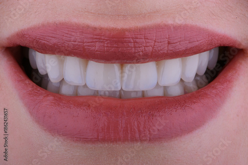 Female smile makeover by dental ceramic veneer, porcelain laminate veneers.