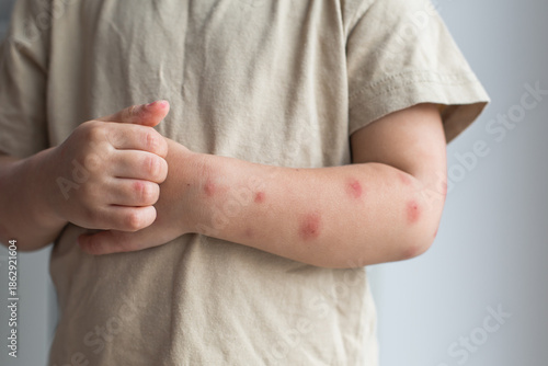 Close-up of a child s arm with multiple red irritated insect bites and scratches, concept of skin allergy, mosquito bites, irritation and healthcare awareness for children