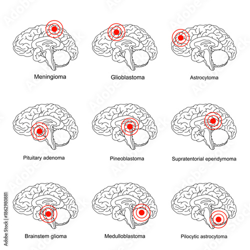 Primary brain tumors illustration. Glioblastoma, meningioma, pituitary and pineoblastoma. Cancer in cerebellum medulloblastoma and pilocytic astrocytoma. Vector illustration for medical and edication