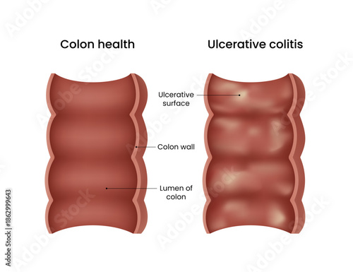 Colon Health vs Ulcerative Colitis A Visual Comparison