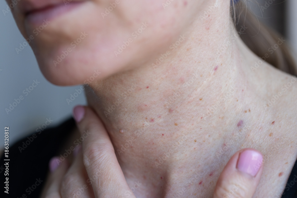 Fototapeta premium Female neck after beauty injections. Biorevitalization concept.