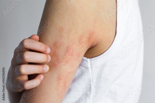 Child scratching irritated elbow with visible atopic dermatitis eczema symptoms, dry red patches on sensitive skin, chronic allergy condition, pediatric dermatology problem, itching discomfort concept