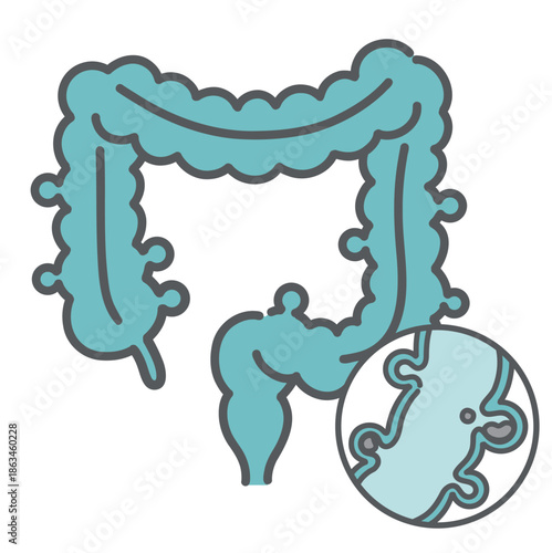 大腸憩室症の全体像と内部構造（便の詰まり）の図解イラスト