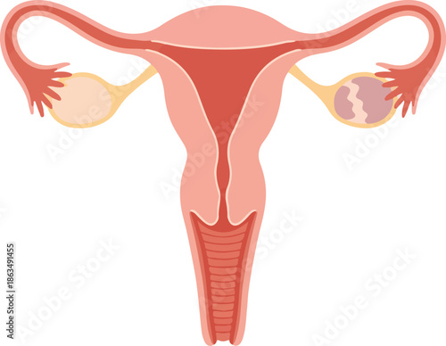 A detailed vector illustration of the female reproductive system, focusing on the uterus and ovaries with a cyst, set against a white background. Perfect for medical presentations,