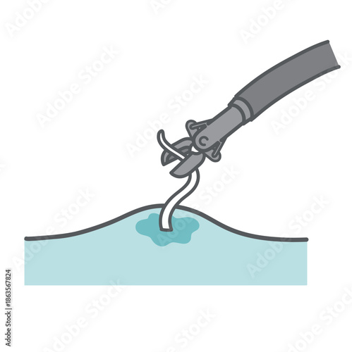 内視鏡によるアニサキス摘出・除去のイラスト