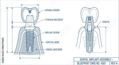 Dental implant assembly blueprint technical illustration