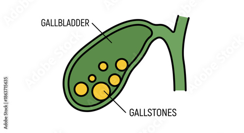 Human gallbladder showing gallstones medical vector illustration