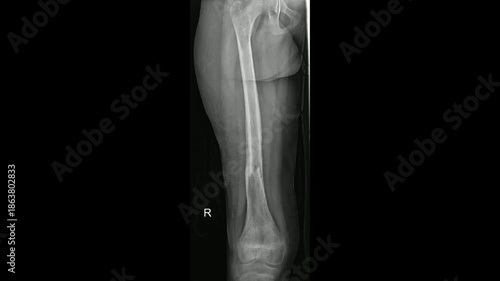 xray of femur fracture ap view 
