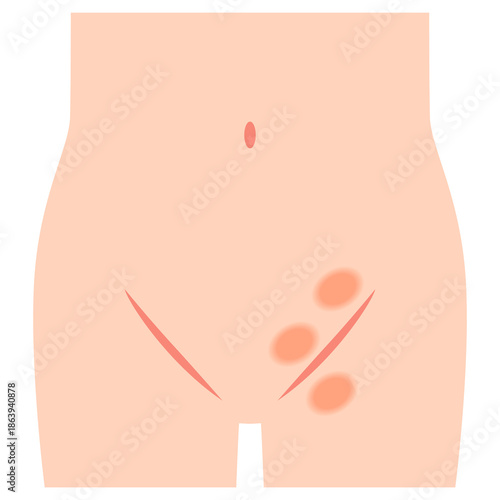 鼠径ヘルニアの種類　ヘルニア　股関節