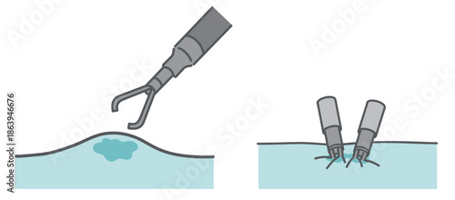 内視鏡的止血術のビフォーアフター（クリップ処置の前後比較）