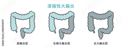 潰瘍性大腸炎の病変範囲分類（直腸炎型・左側大腸炎型・全大腸炎型）