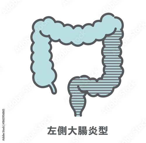 潰瘍性大腸炎・左側大腸炎型のイラスト（病変範囲）