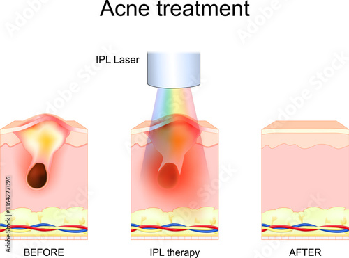 IPL therapy. Acne treatment. Skin before and after Intense pulsed light procedure