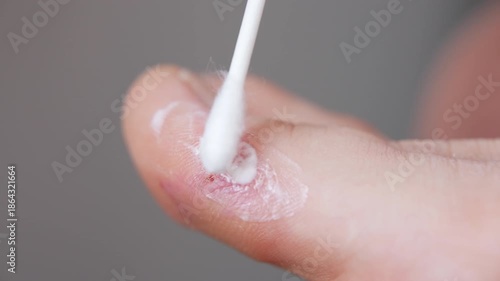 Process of applying medicinal ointment on acute dyshidrotic eczema on human toe, irritated skin with dry peeling, wounds and lots of small blisters with itchy and painful symptoms, widespread