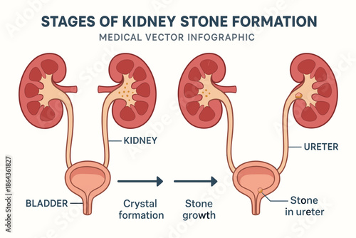 Stages of kidney stone formation infographic with kidney, bladder, ureter details