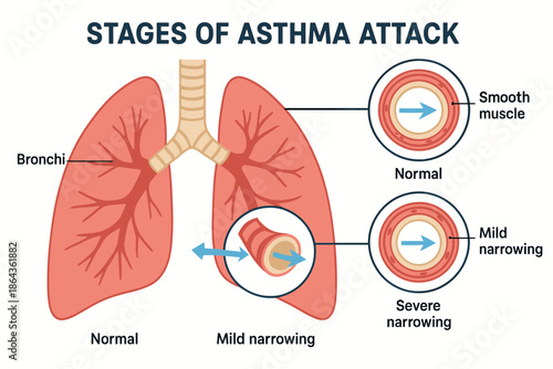 Stages of asthma attack with lung diagram and bronchi analysis