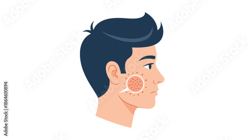 Side profile of a man's face with a circular magnification focusing on an area of red acne breakouts on his cheek.