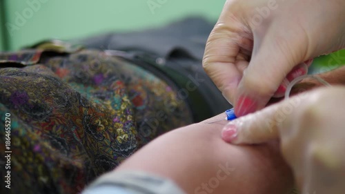 Medical nurse Inserting Butterfly Needle into Arm. vitamins on iv drip in clinic for healthcare treatment, medication or healing. Medical checkup, infusion and patient in hospital office for wellness