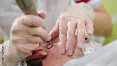 Beauty laser anti wrinkle procedure. Resurfacing facial skin with laser. Modern innovative medical equipment. laser face polishing in cosmetology or plastic surgery clinic. skin rejuvenation using