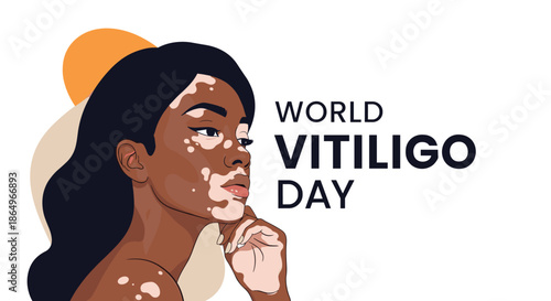 World Vitiligo Day banner featuring a beautiful woman with vitiligo, promoting awareness, acceptance, and skin positivity.