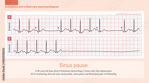 Although the diagnostic criteria of sinus pause defined by ESC and AHA are greater than or equal to 2S and 3S, respectively, some exceptions sometimes occur.
