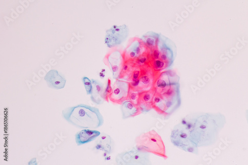 Abnormal human squamous epithelial cells view in microscopy.HPV criteria for pap smear slide cytology and pathology.Koilocyte cells on white background.Woman cervical cancer cell medical concept.