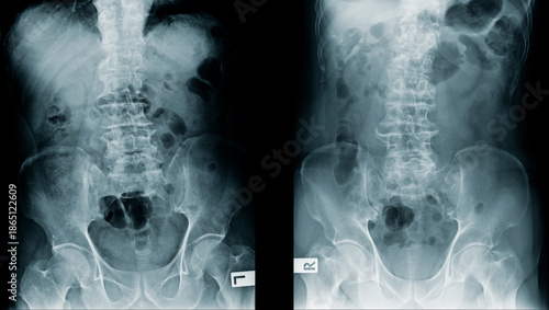 Tableau sur toile X-ray images of a degenerated spine both picture, severe lumbar spondylosis view