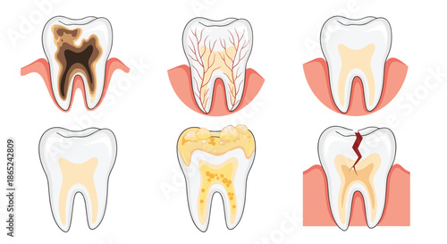 Set of six illustrations showing various common dental problems, including tooth decay, cavities, plaque, inflammation, and a cracked tooth.